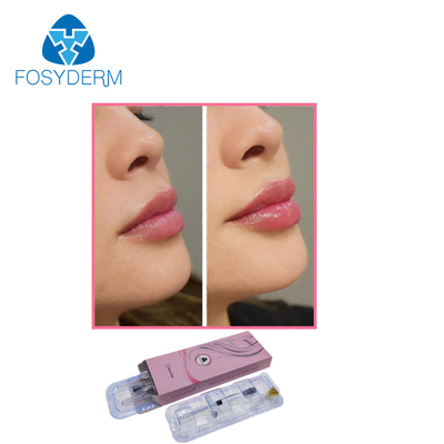 Remplisseur cutané d'injection d'acide hyaluronique de l'esthétique 1ml de Fosyderm pour l'amélioration de lèvres